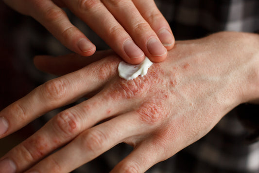 Tips for Managing Eczema