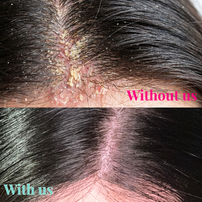 A close-up before-and-after comparison of a person's scalp and hairline, showing dandruff and scalp flakes under the text 'Without us' in pink and 'With us' in light blue. The top panel shows a inflamed scalp with visible flakes and dry hair, while the bottom panel shows a clearer, healthier scalp with less flaking.